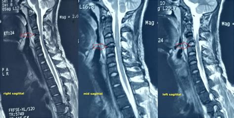 cervical compression constitute objective test serious injury|c3 and c4 cervical injury.